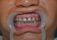 成都男子数万元做“口腔医美”，一口牙全毁了