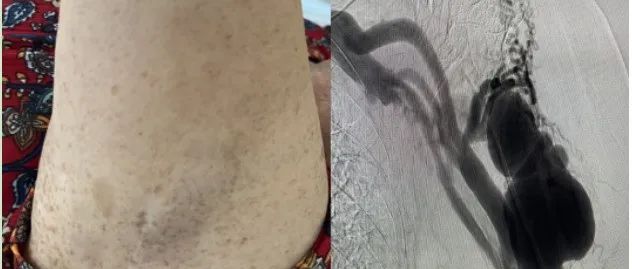 出现“蚯蚓腿”？血管堵车？别慌！介入血管外科亚专业门诊来帮忙
